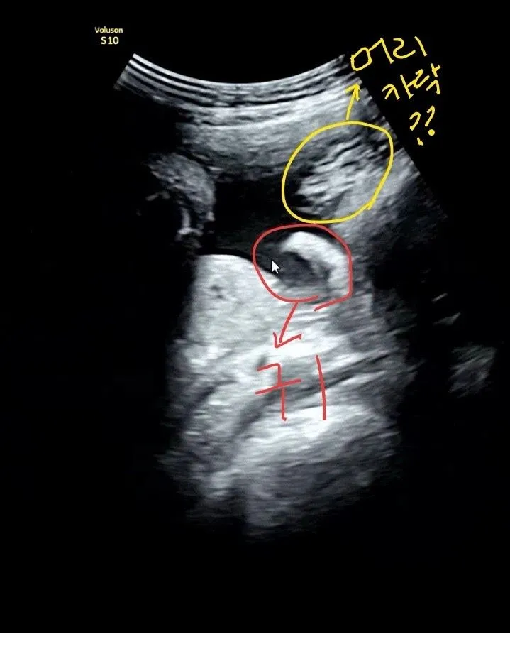 34주 초음파 머리카락?