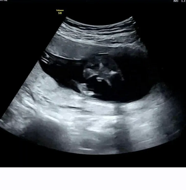 15주 5일 다리 사이 같이 봐주세요!! 3