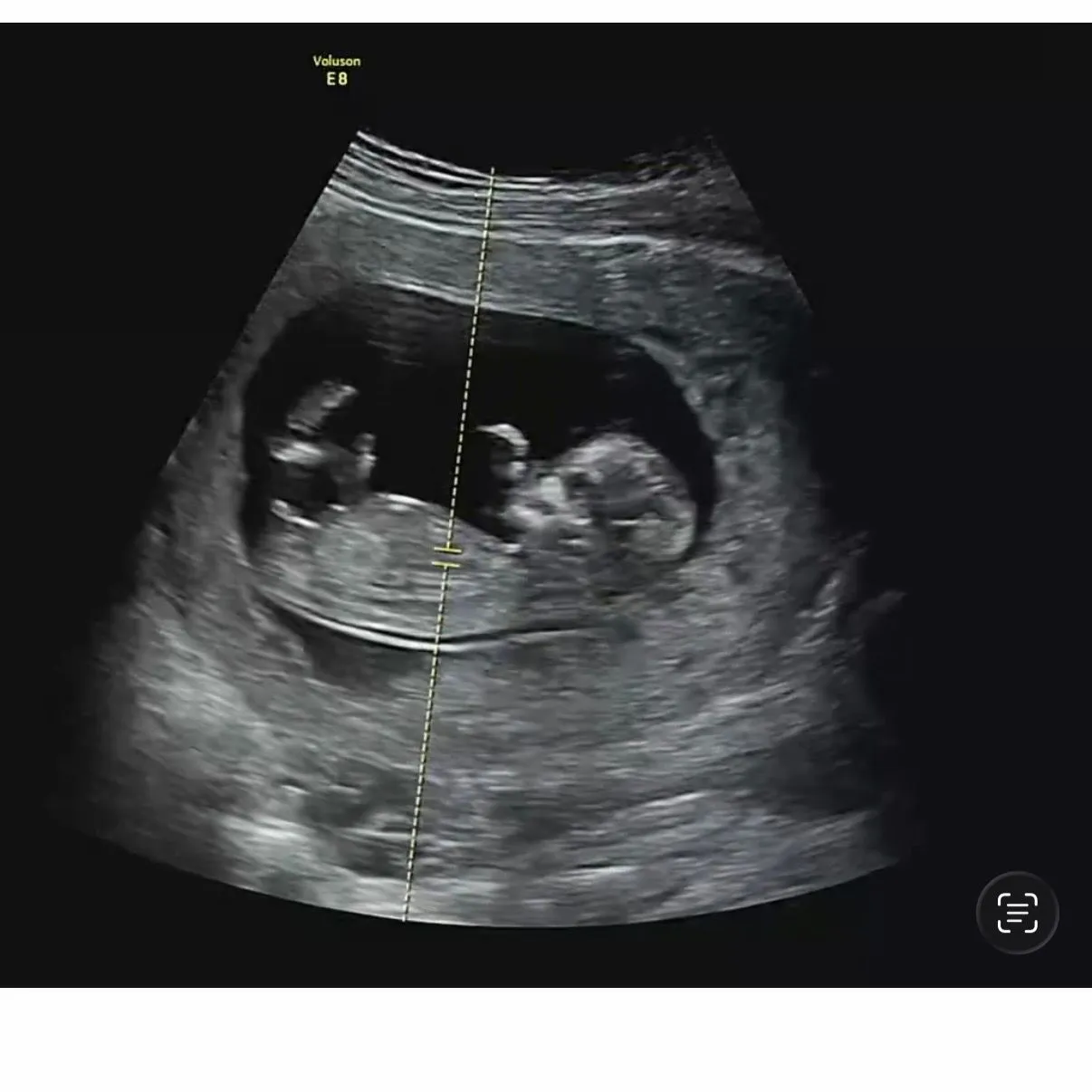 12주0일 각도법 성별투표 마구마구 해주세용!!! 4