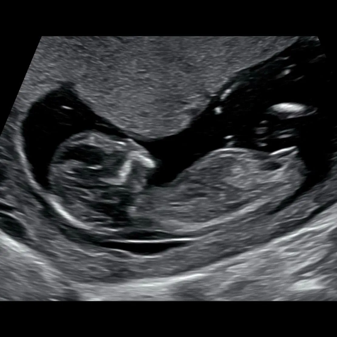 12주 5일 성별 각도법 봐주세요👶🏻