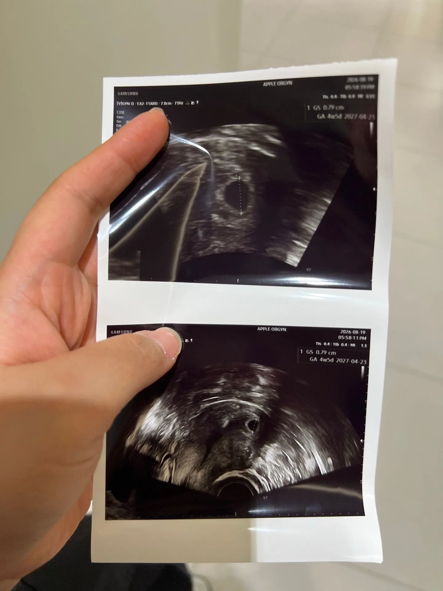 테니스치고 5주3일 초음파ㅜㅜ 다들 운동 언제 시작하셨나요? 1