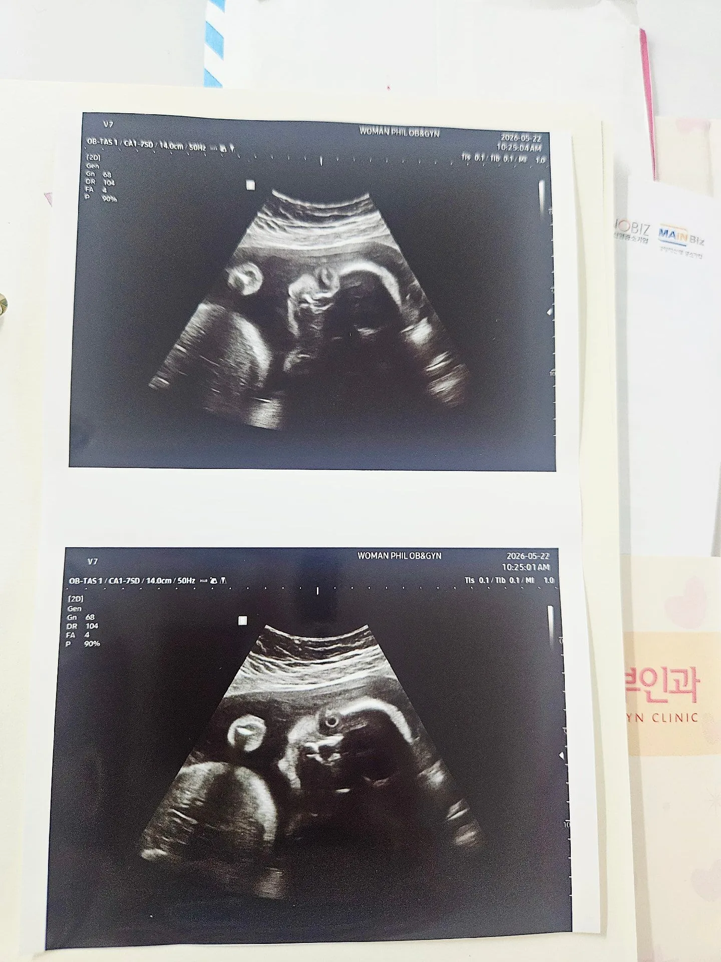 눈을 감아도 초음파에 눈동자가 잡히나요?