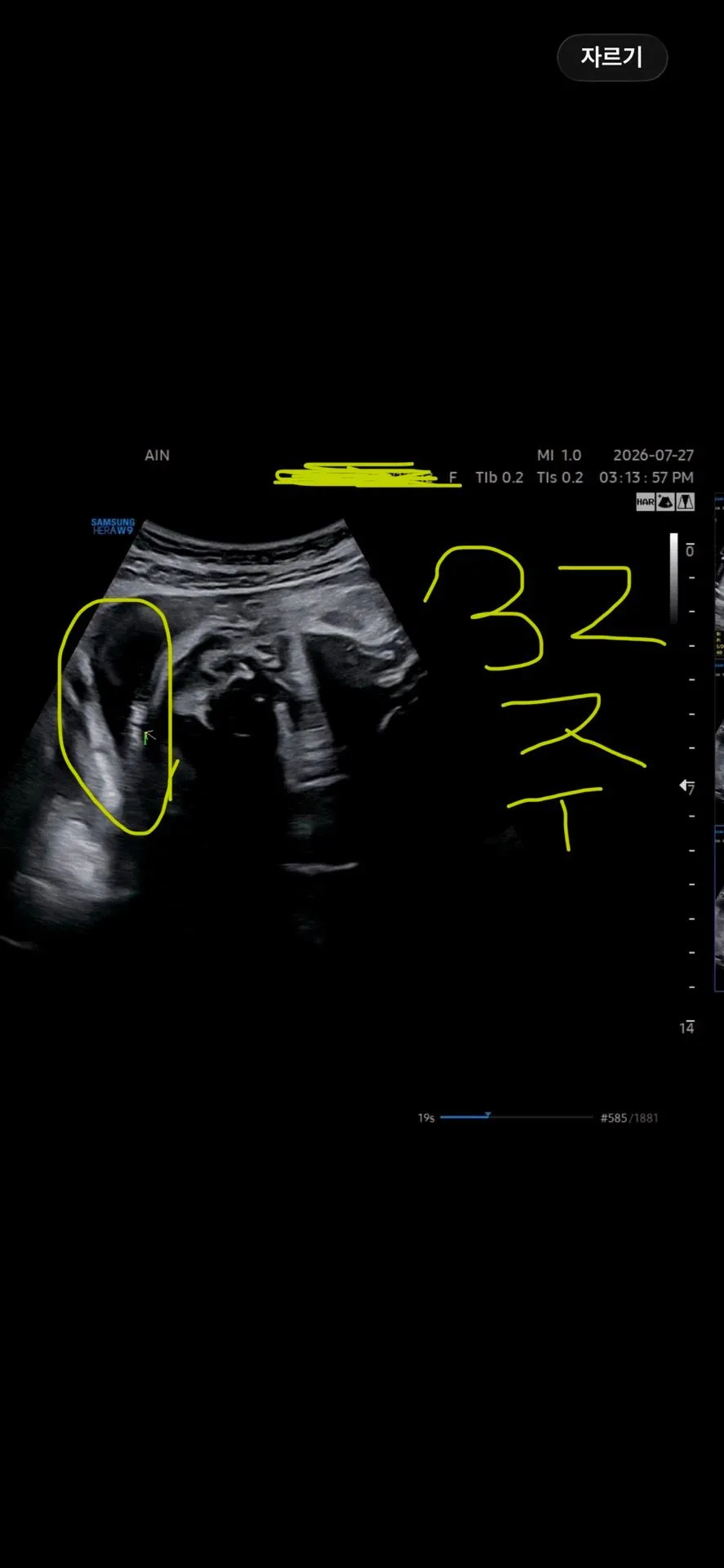 32주차 초음파 아기 머리카락 이게 맞나욥?🥹 2