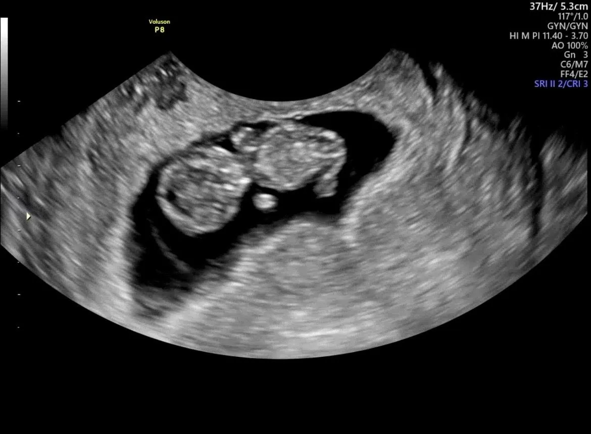 9w4d 피고임 봐주세요😭 2