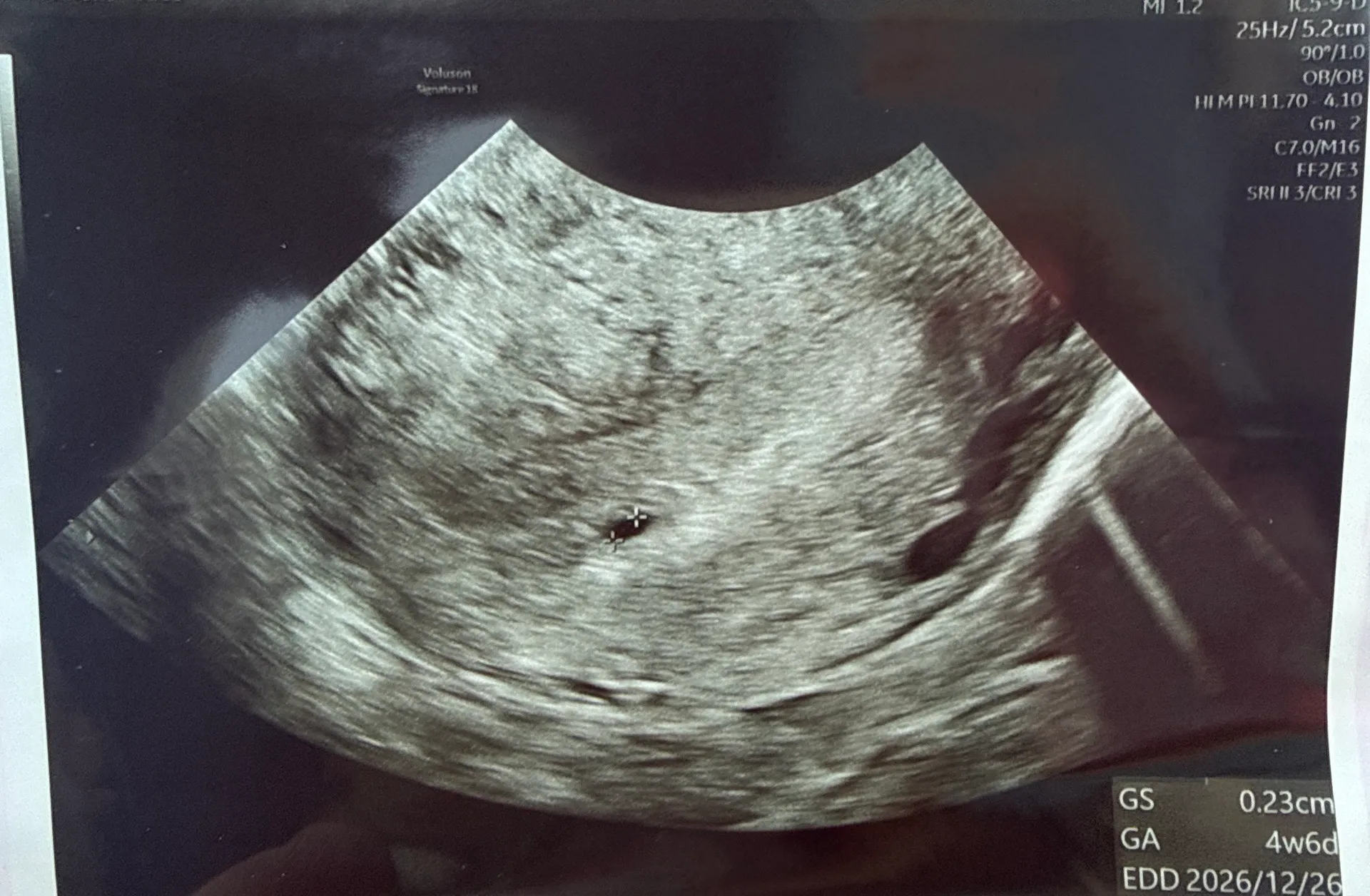 4주 6일 아기집 크기 괜찮은건가요,,?!