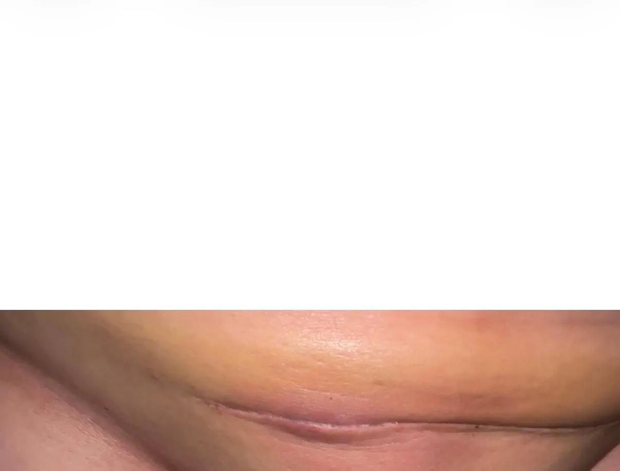 제왕절개 수술부위 붓기(사진있음) 2