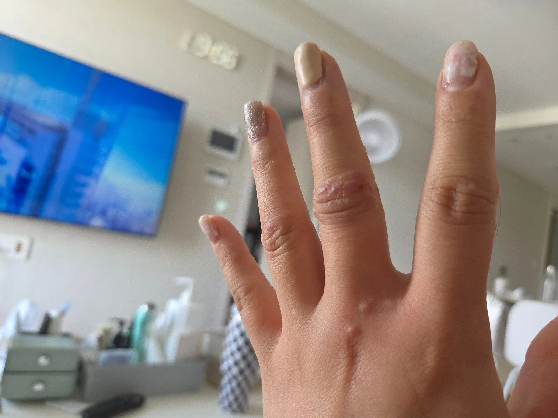 임신초기 한포진...아ㅜㅜ살려주세요 3