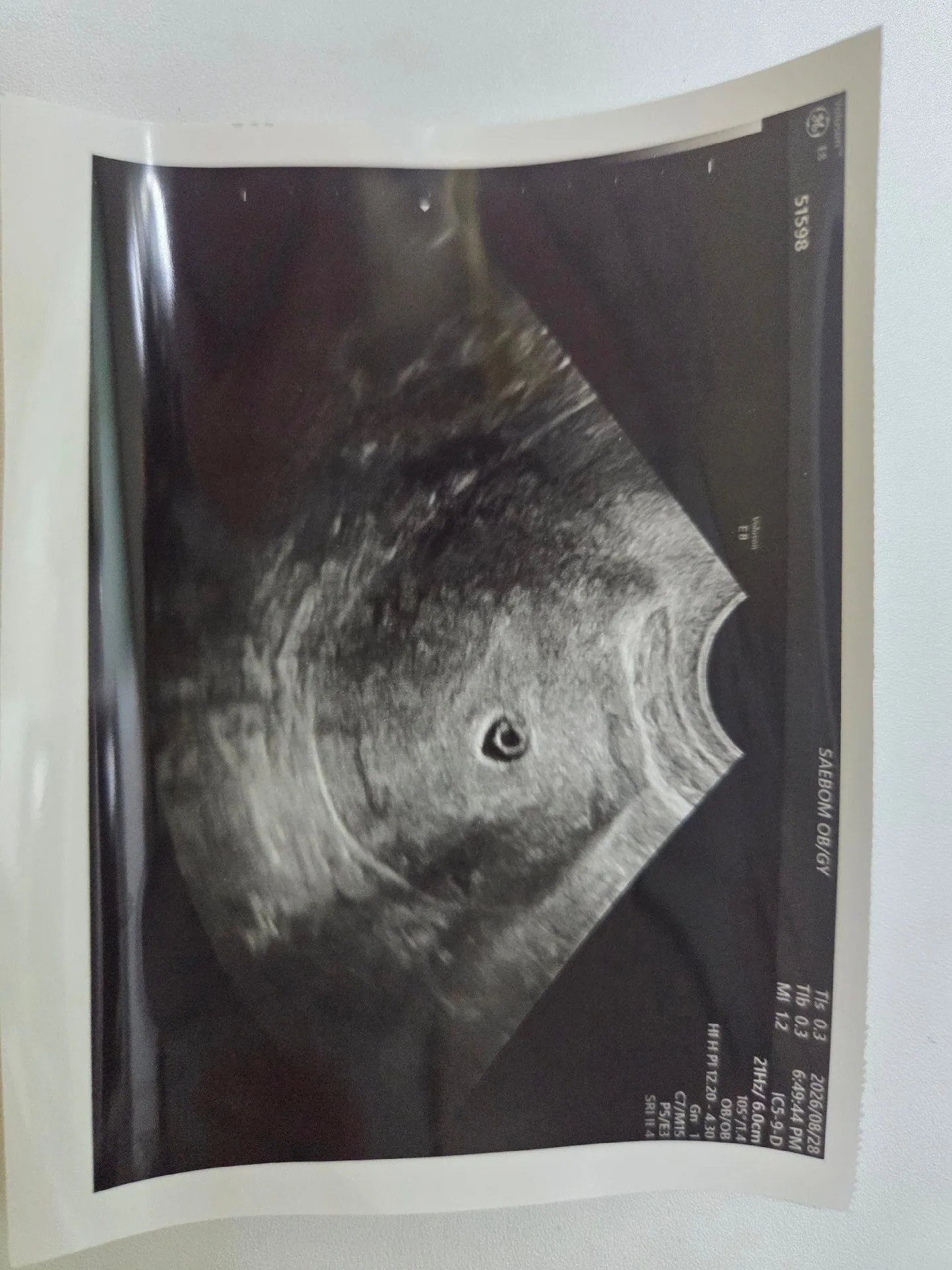 5주 5일 아기집이 작아요ㅜㅜ