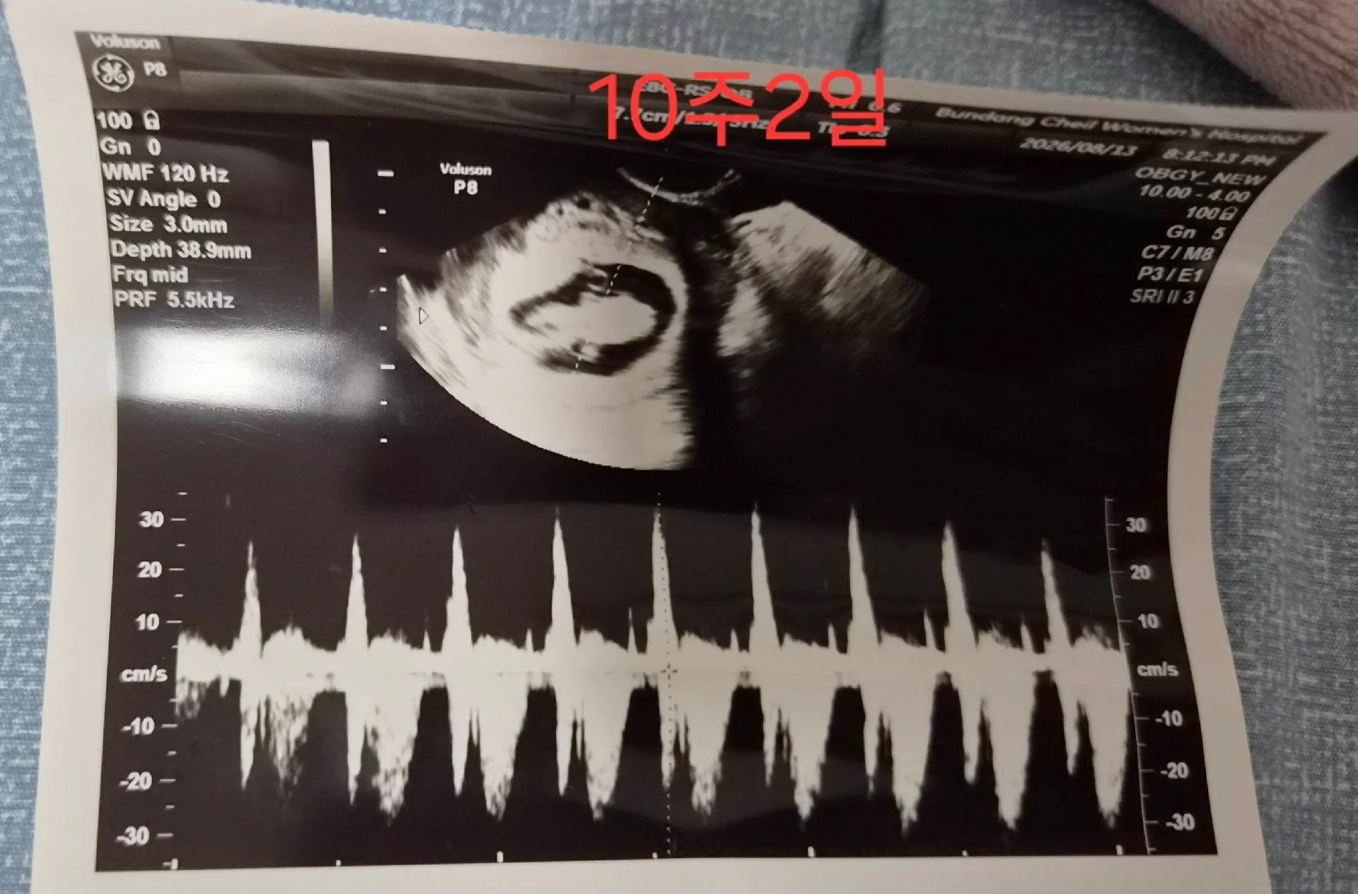10주2일인데 갑자기  분비물도 나오고 배가 뭉쳐서,, 1