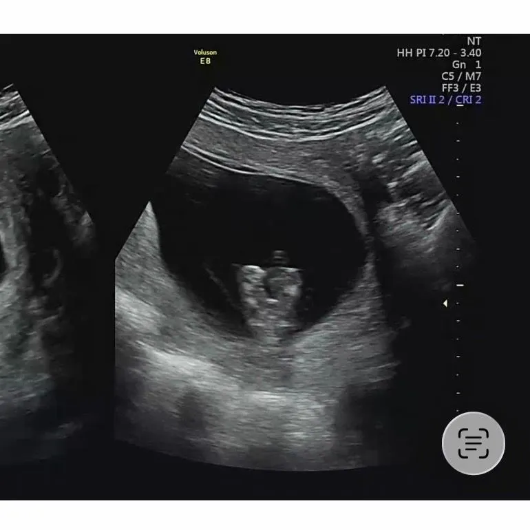 12주0일 각도법 성별투표 마구마구 해주세용!!! 3