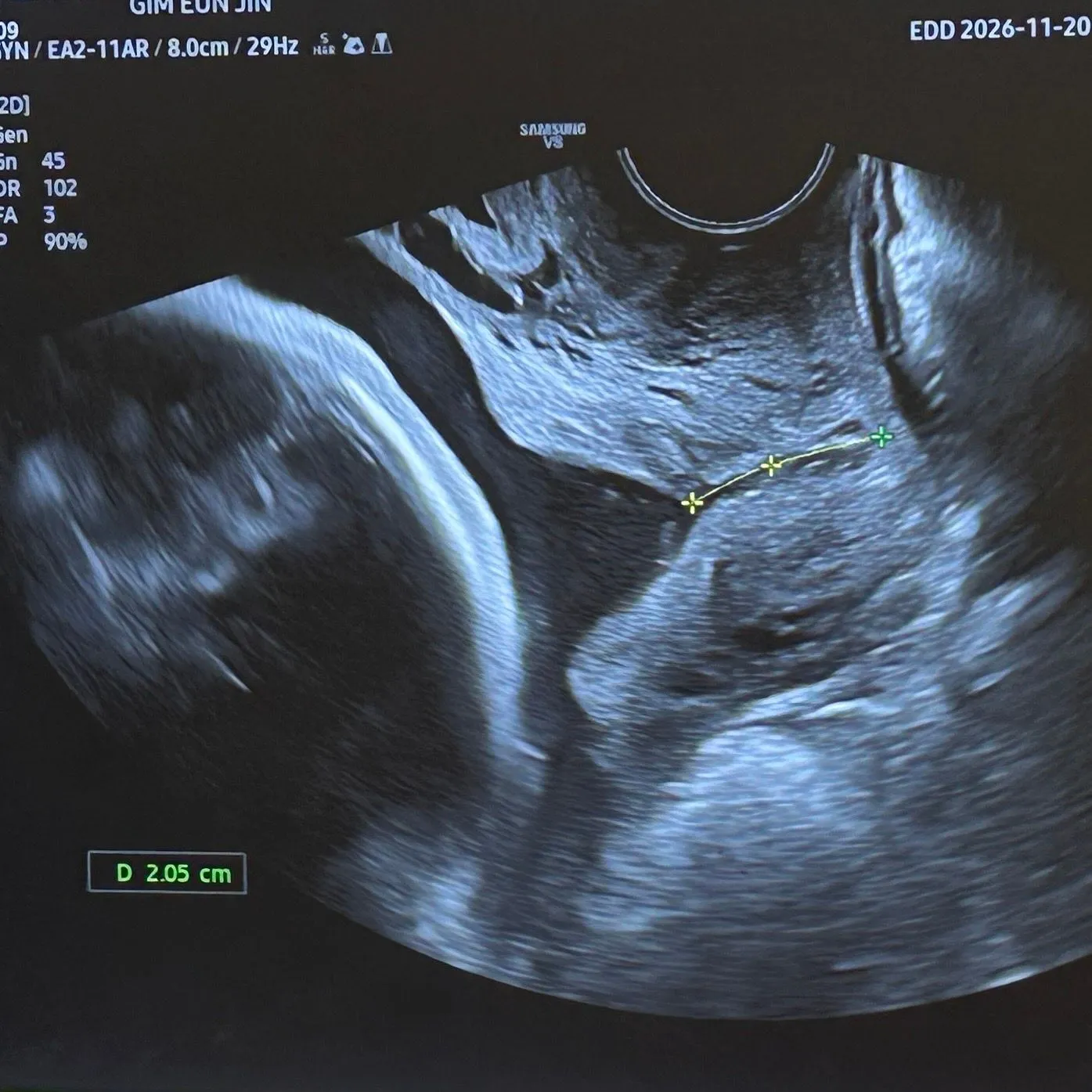 29주차 경부길이 1.7cm에서 2.0cm 괜찮을까요?