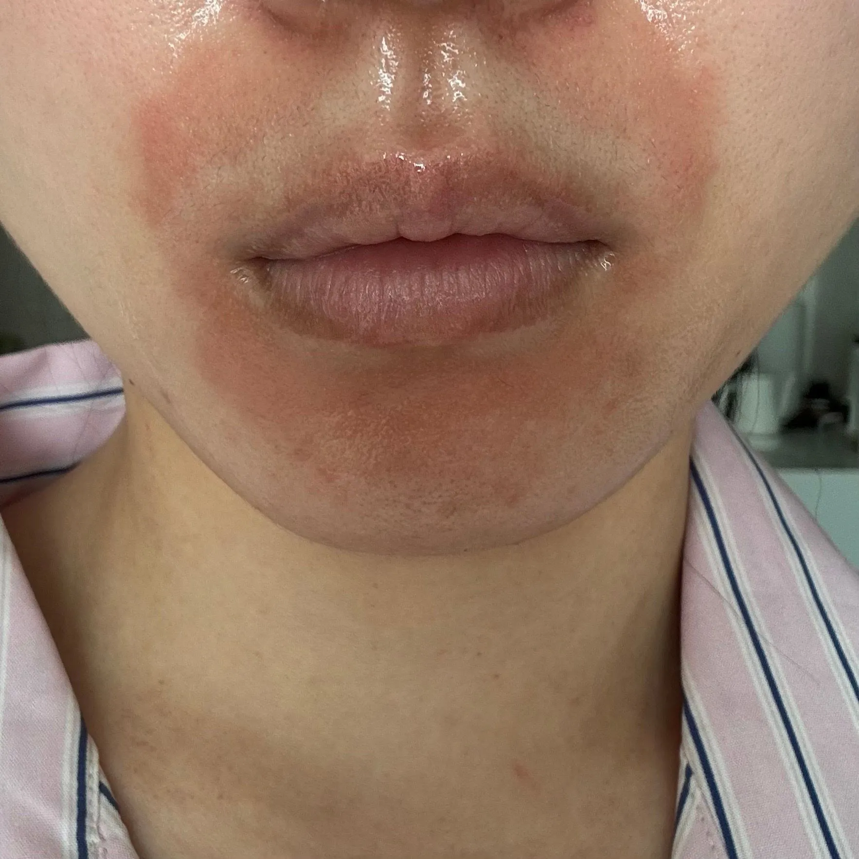 (사진약간징그러움) 입주변 빨갛게 다 트고 뒤집어진 분 계신가요? 2