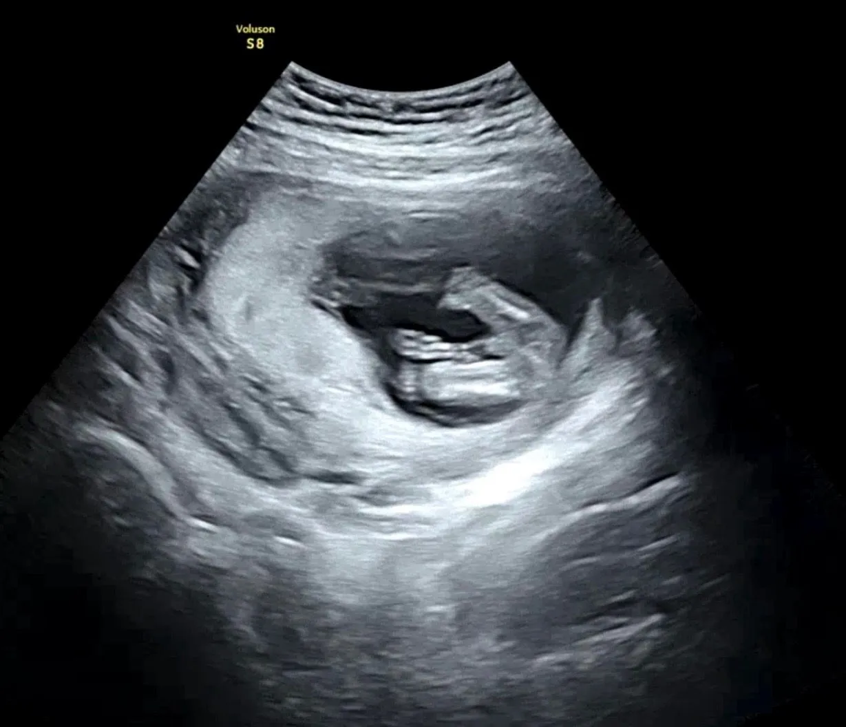14주차 🌶️일까요 탯줄일까요🤔🤔 2