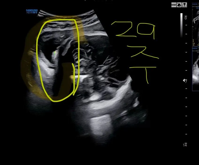32주차 초음파 아기 머리카락 이게 맞나욥?🥹 1