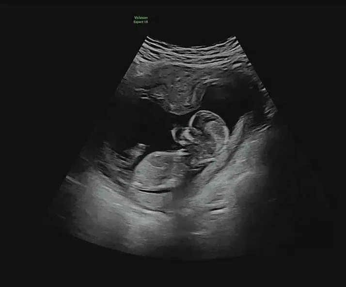 12주5일 성별 궁금해요! 1
