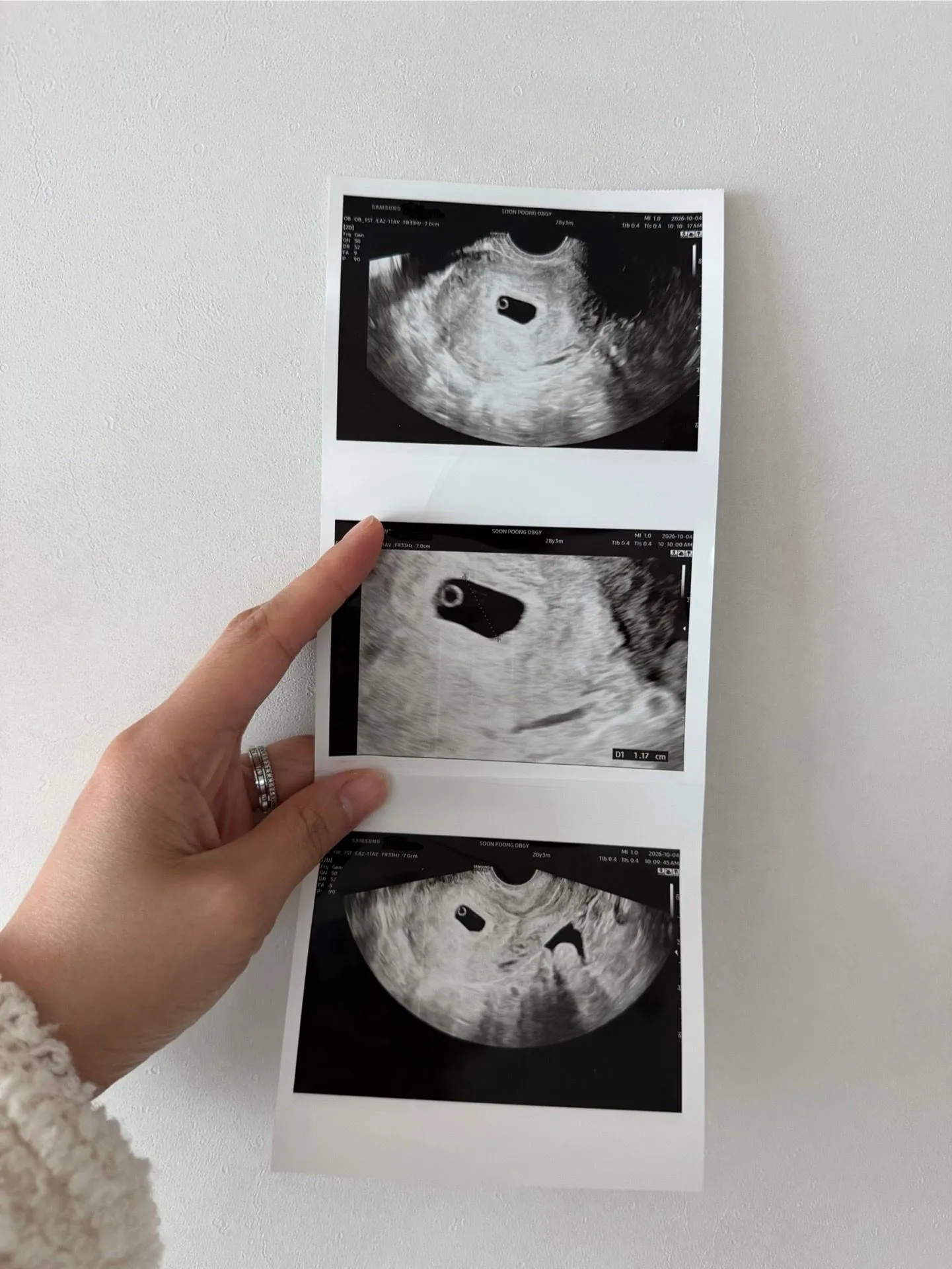 병원 이동에 따른 주수 산정법 차이 2