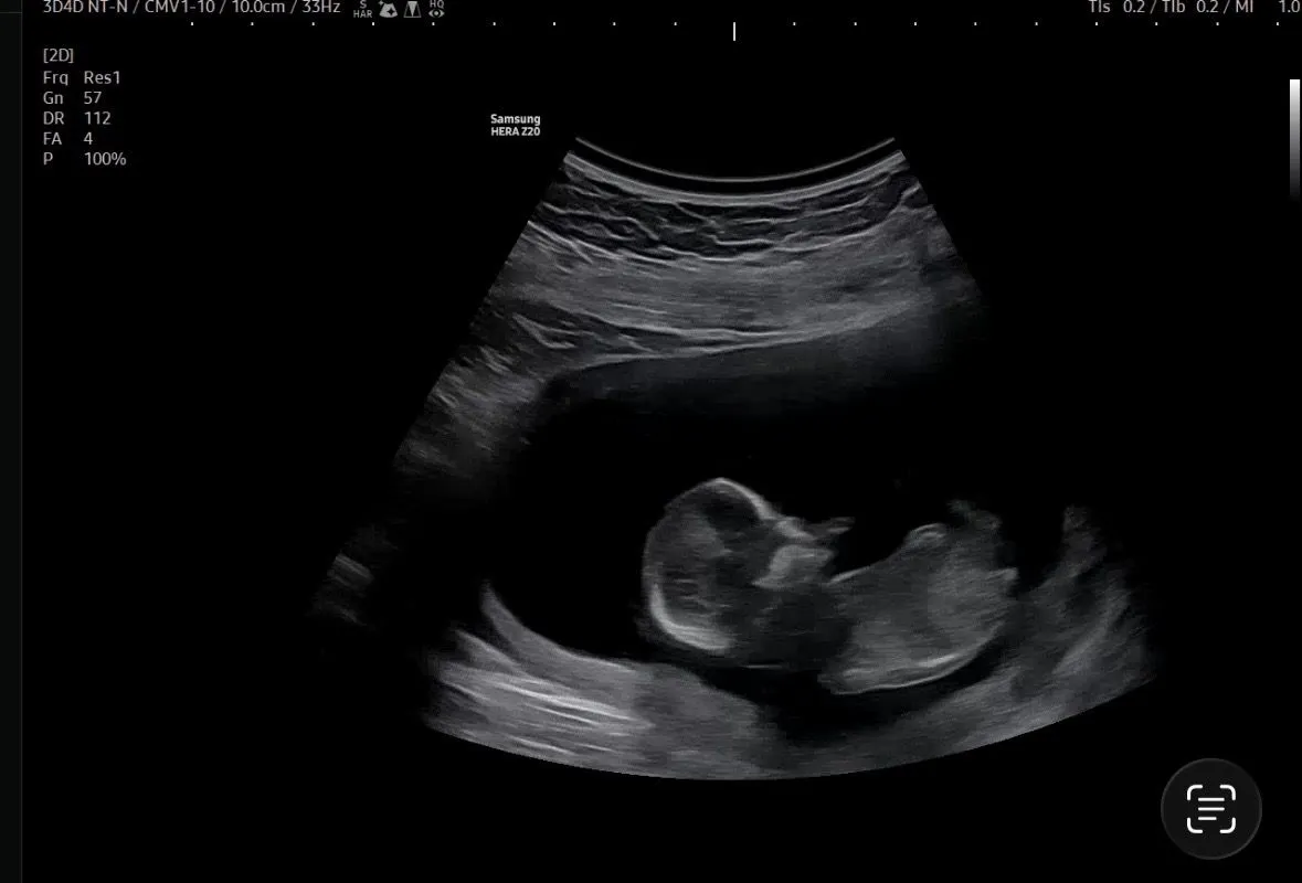12주4일 각도법 마구마구 성별 유추해주세요🥲 2