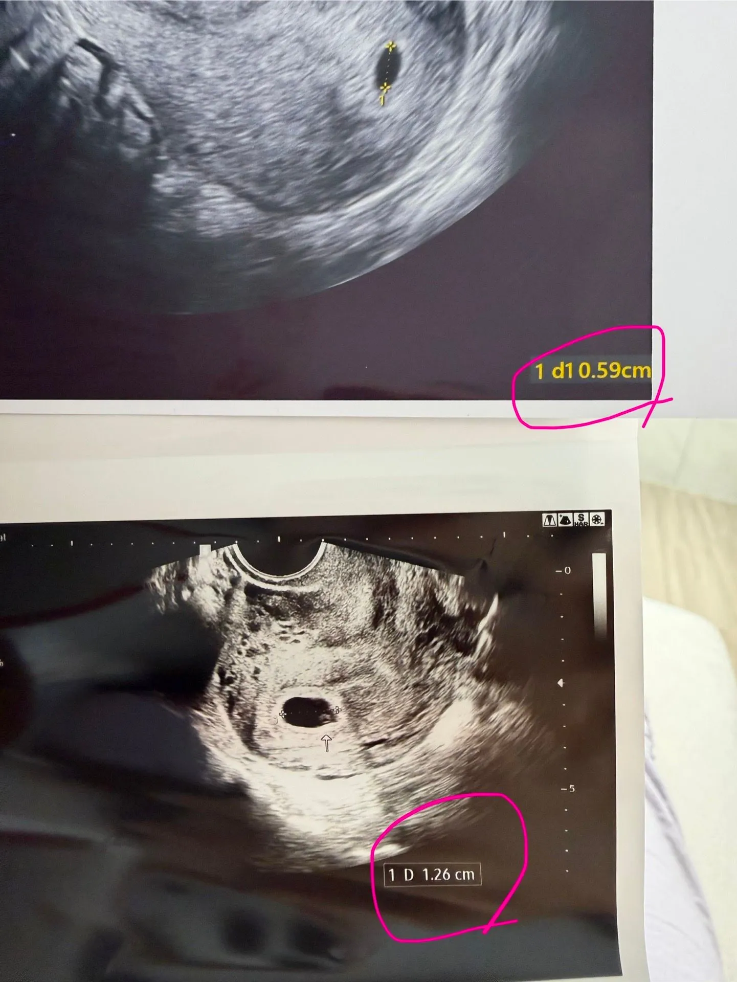 이틀만에 애기집크기가 두배차이?!