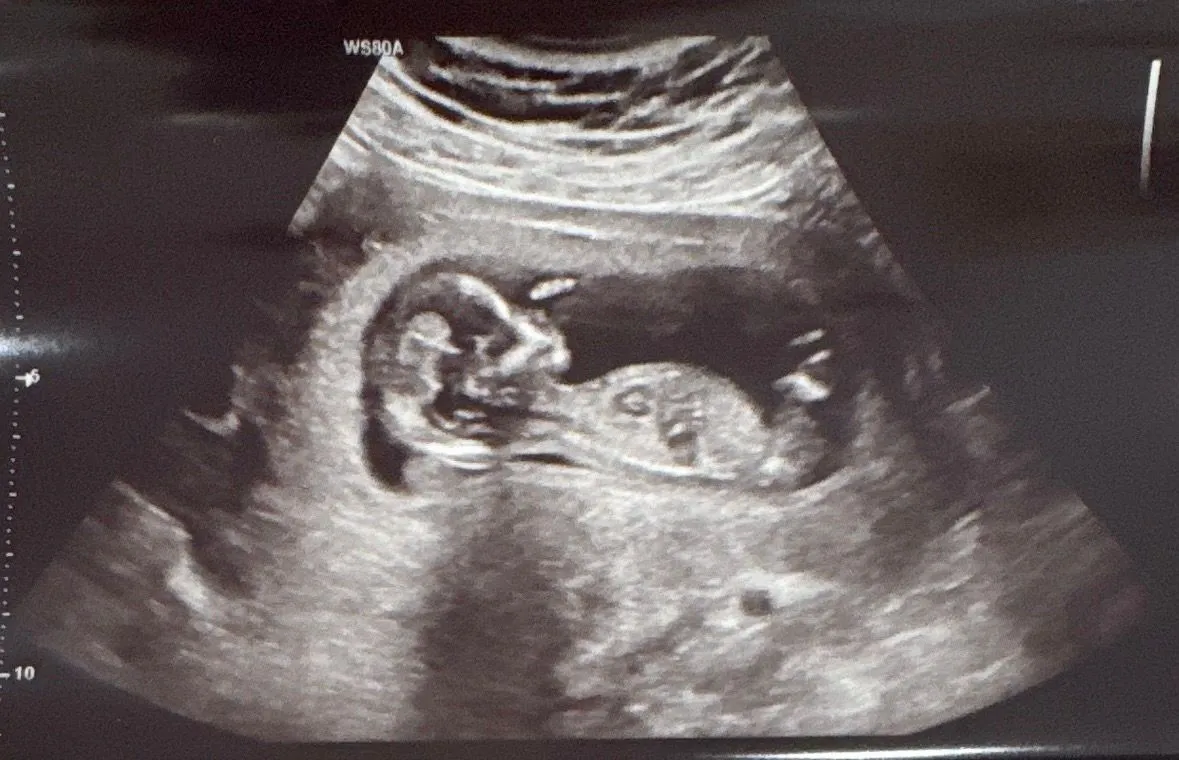 13주 촘파 각도법 볼수있을까요?? 2
