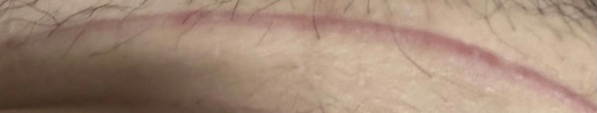 제왕절개흉터가 원래 이렇게 빨갛게 아무나요?