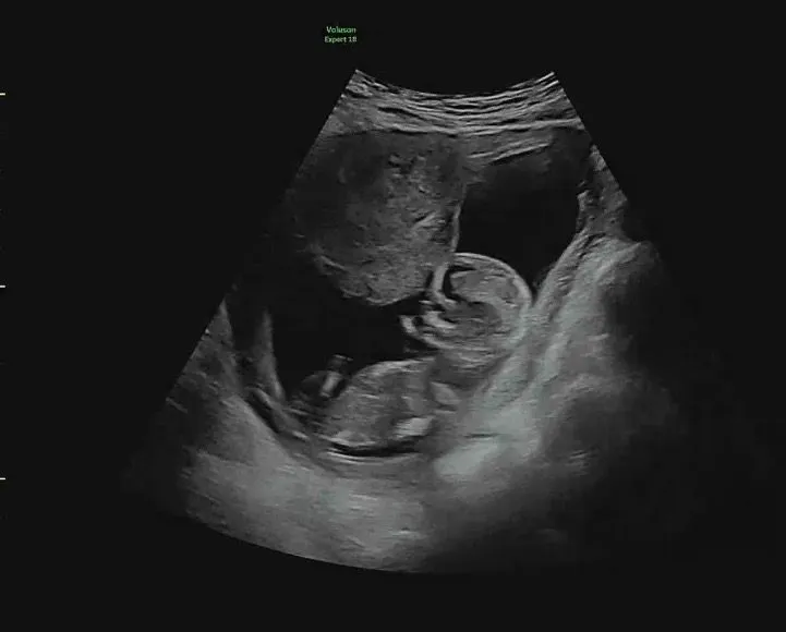 12주5일 성별 궁금해요! 2