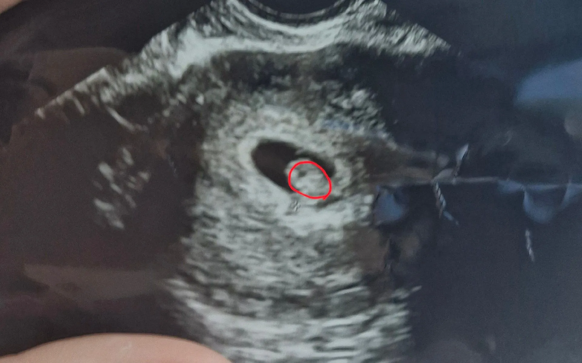 5주1일차인데 초음파사진 봐주세요 2