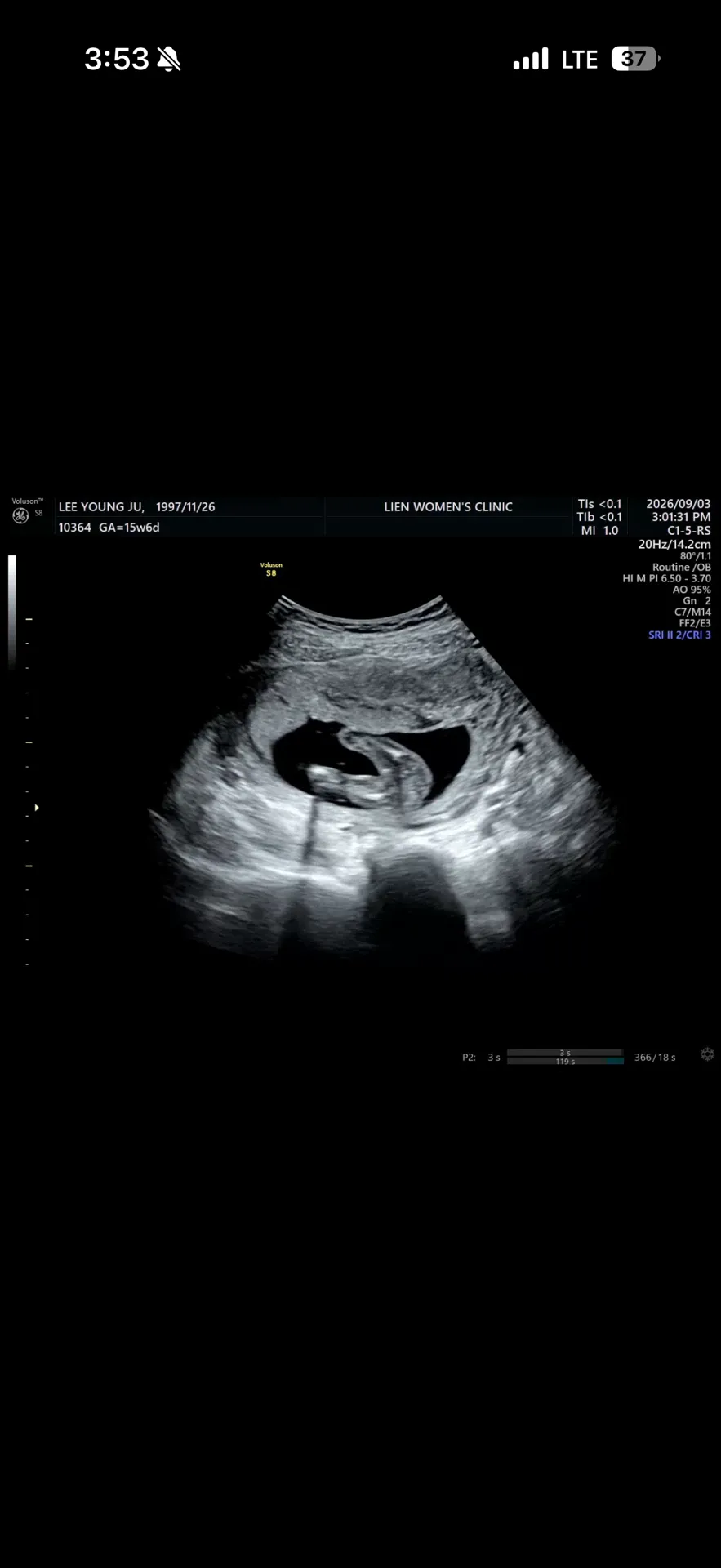 15주 6일차 초음파 빼박 딸이겠죠?