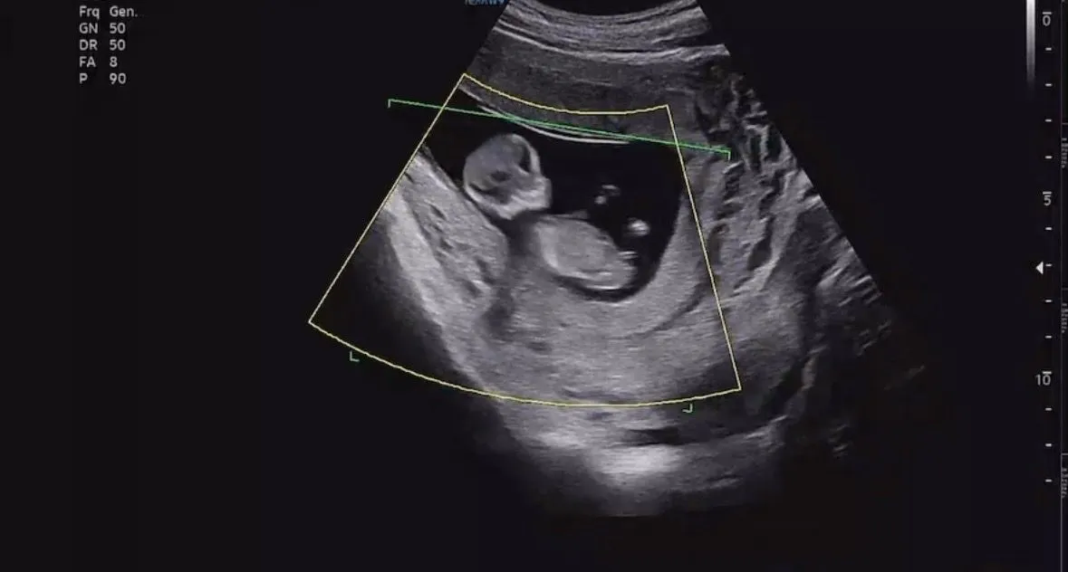 12주 촘파 아들일까요? 딸일까요? 투표 마구마구 해주세용 3