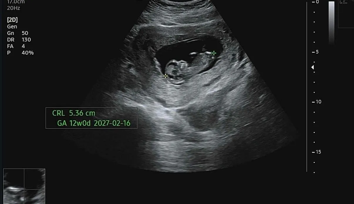 12주0일 각도법 봐주세요 3
