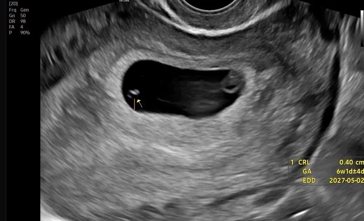일란성 쌍둥이 가능성 ?  1