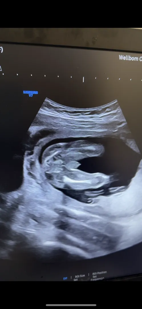 17주 아들 확정👶🏻