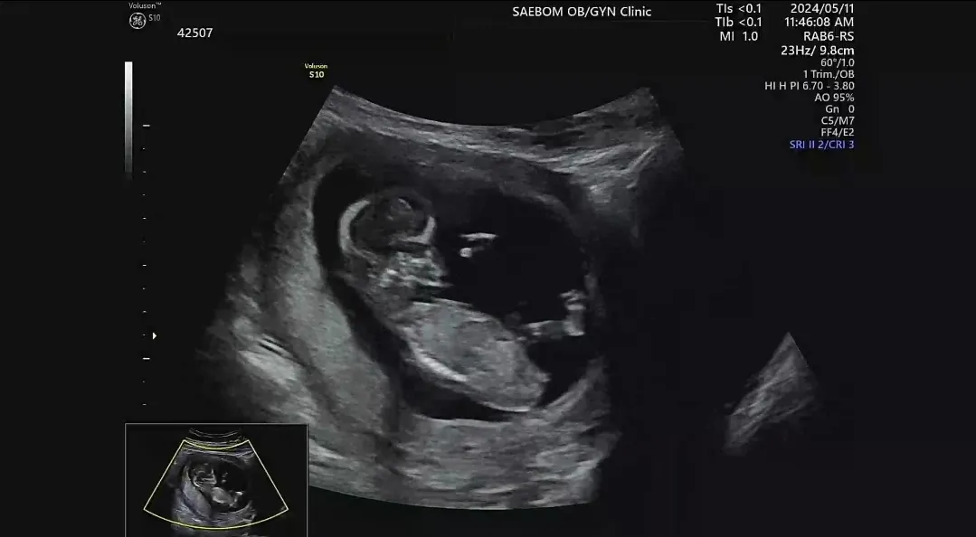 12주 초음파 딸인걸까요!?