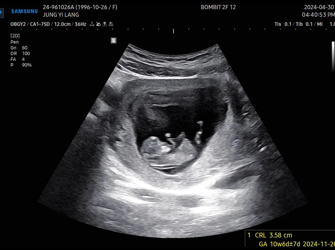 5월16일 1차 기형아 검사