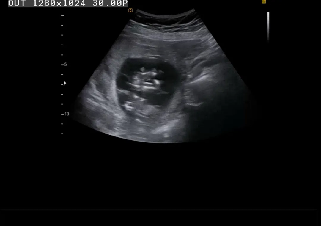 13주 성별 듣기 ! 딸둥이들 👶🏻💓👶🏻(일란성)
