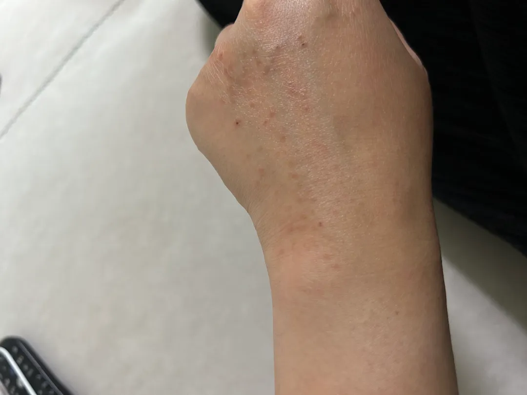 혹시 피부 간지러우신분들 있어요? ㅠㅠ