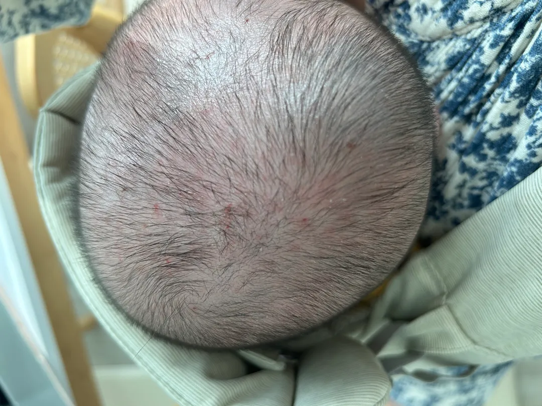 애기가 머리를 심하게 긁어요 ㅠㅠ 