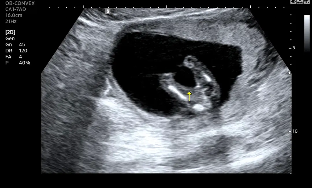 14주5일 딸맘 일까용!?
