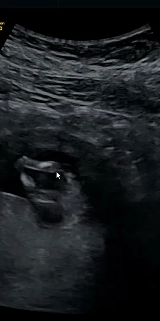 12주 2일 아들? 딸?