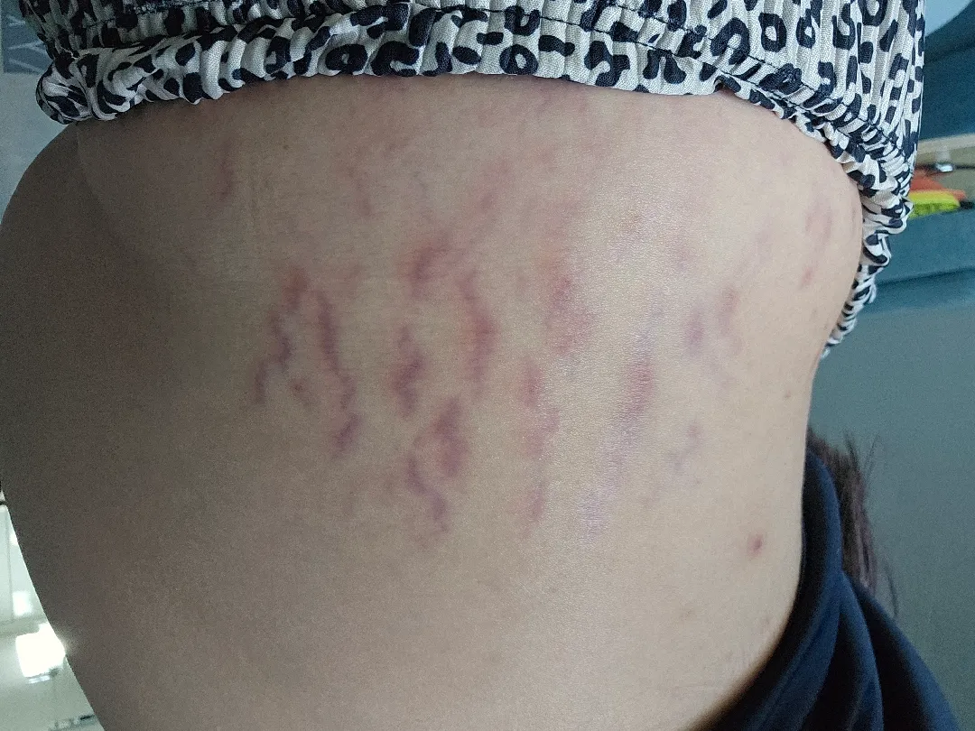 튼살 다들 어떠신가요...