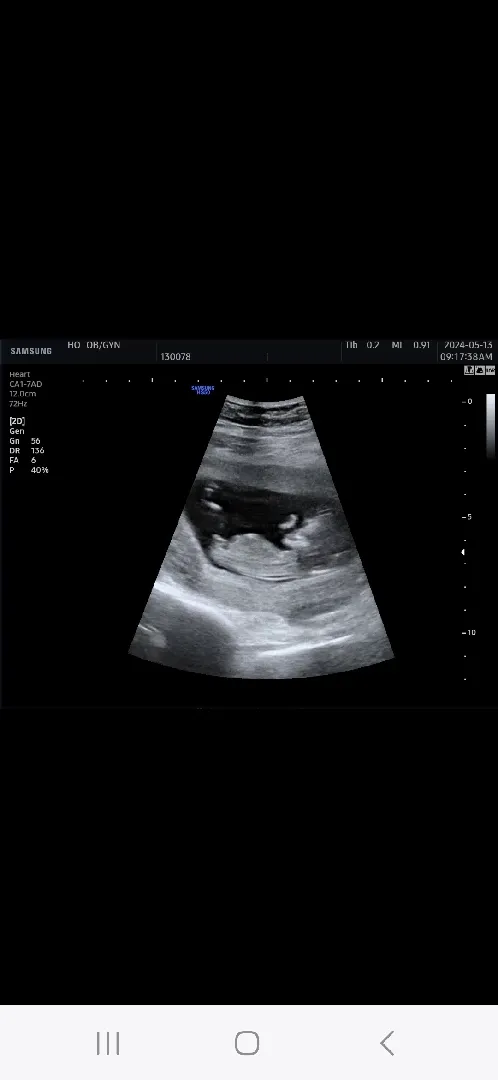 12주차 초음파 딸?아들?