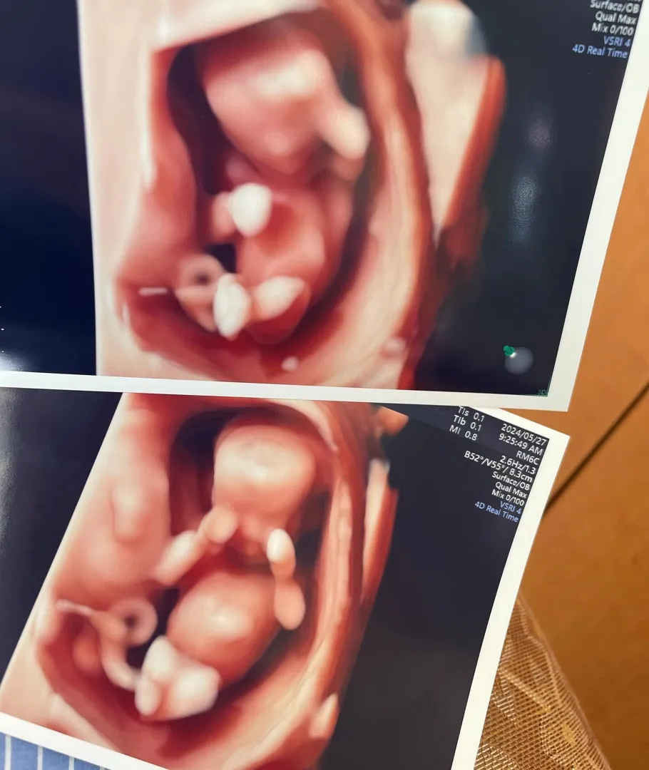 12주6일차 기형아검사&임체초음파