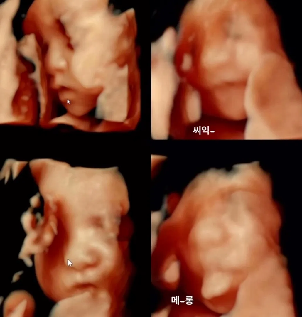 입체초음파 다들 성공하셨나요?
