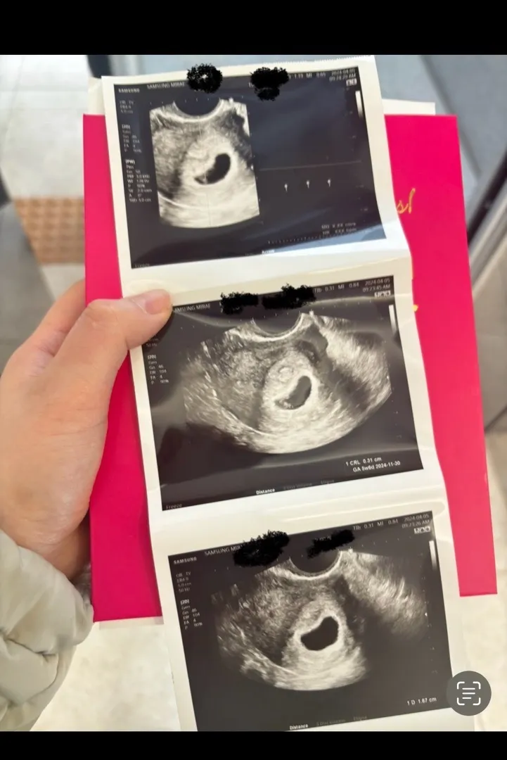 아기집이 좀 찌그러져보이진 않을까요??