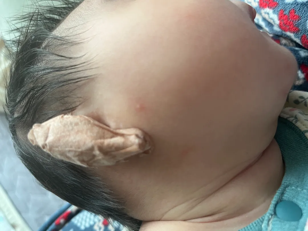 아기 얼굴 뽀루지