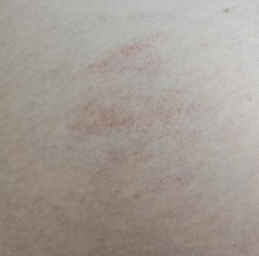 혹시 튼살이려나요? ㅠㅠ
