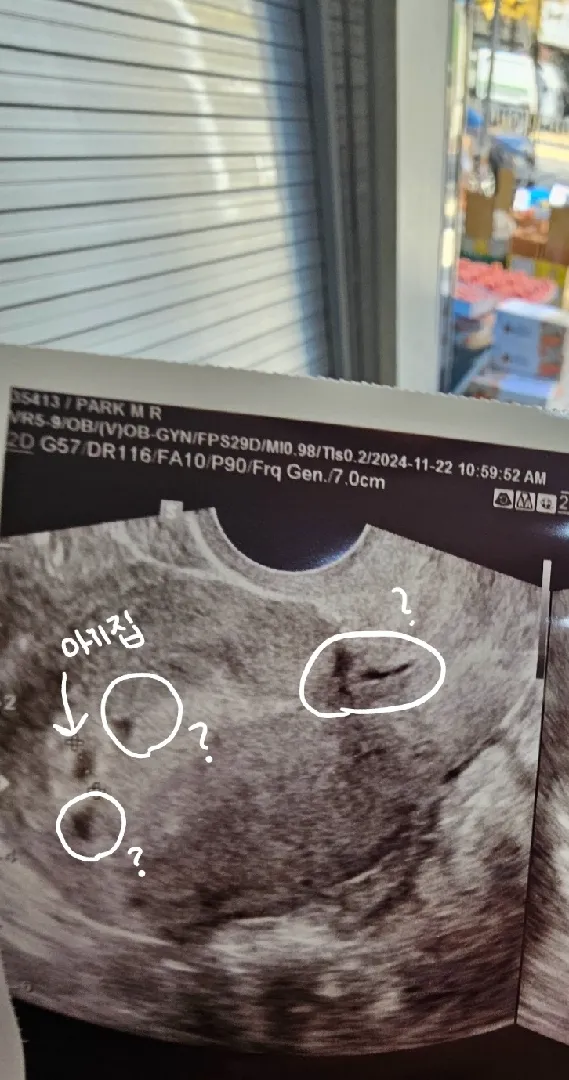 초음파 피고임일까요?