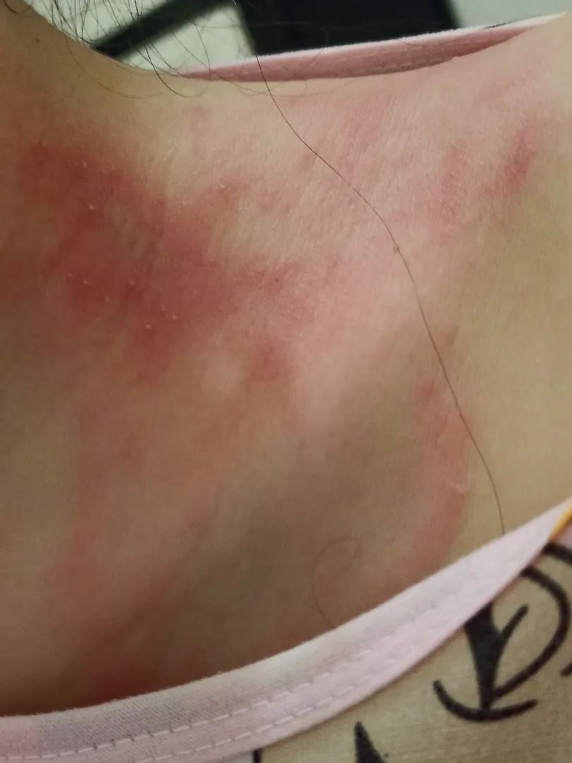 Herpes saat hamil