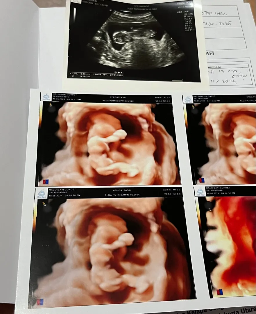 NT scan