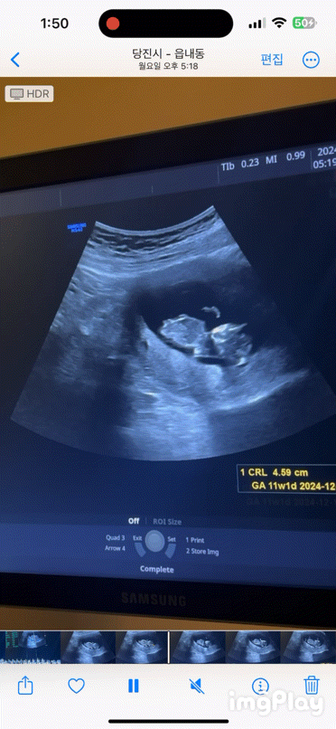11주 초음파 꼼지락