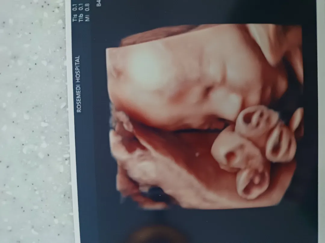 전치태반 잘 아시는분 부탁드립니다